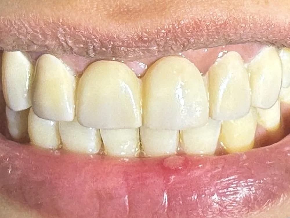 Canine-to-Canine Smile Restoration in Zirconia (after)