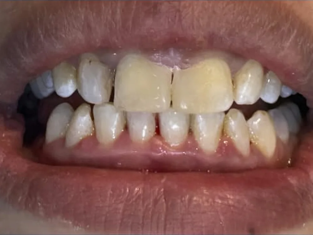 Diastema Closure