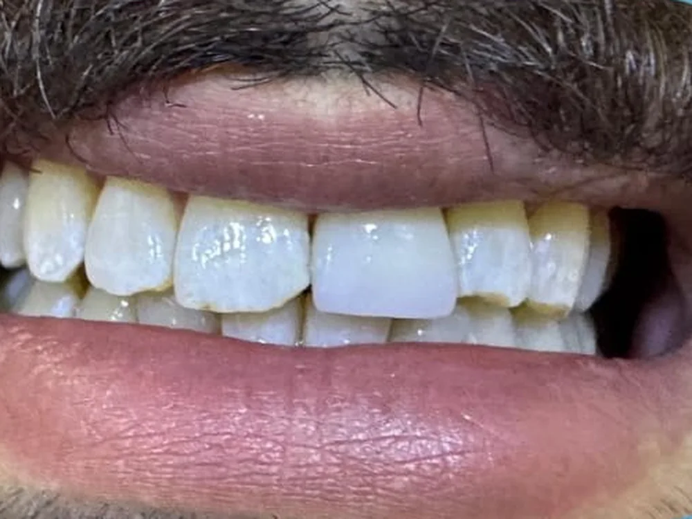 Zirconia Crown