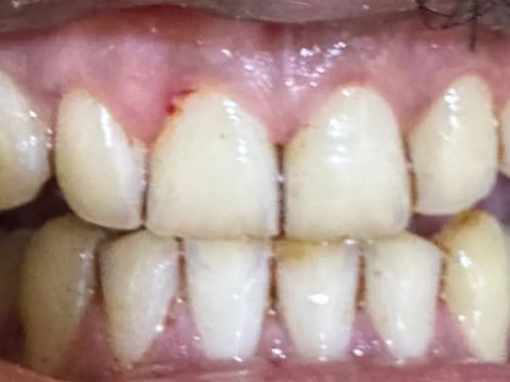 Scaling & Polishing