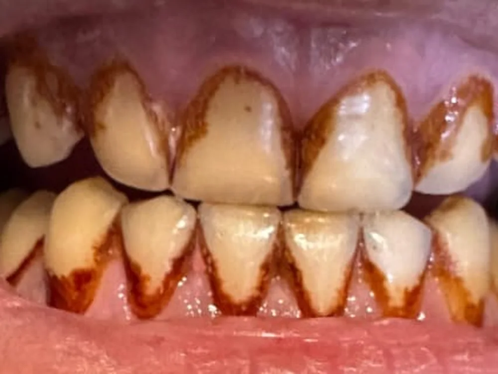 Scaling & Polishing: Heavy Tartar and Stain Removed (before)
