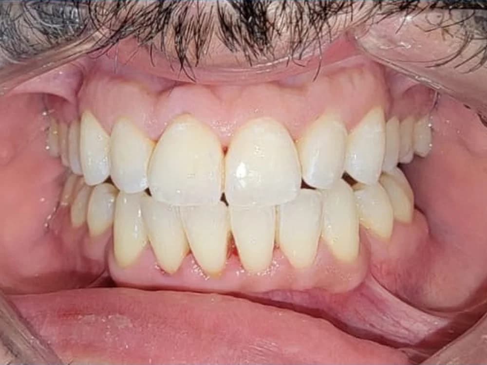 Teeth Whitening After