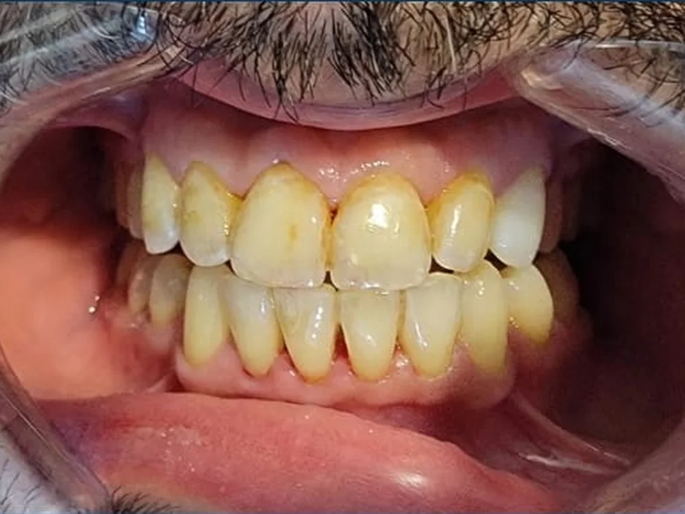 Teeth Whitening Before