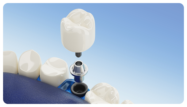 dental implant
