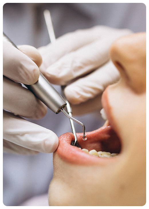Teeth Filling