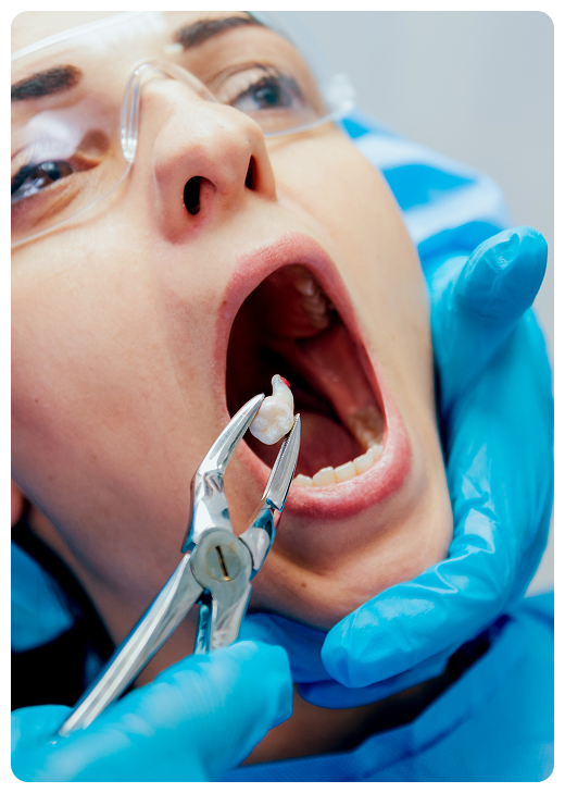 tooth extraction