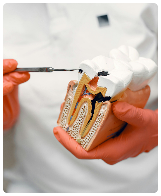 Root Canal